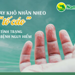 Da tay khô nhăn nheo “tố cáo” 5 tình trạng bệnh nguy hiểm