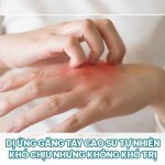 Dị ứng găng tay cao su tự nhiên: khó chịu nhưng không khó trị